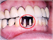 ファイバーコア症例 Before