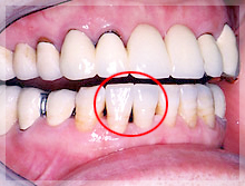 ファイバーコア症例 After