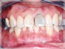 セラミッククラウン症例 Before