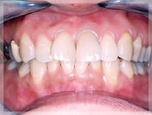 セラミッククラウン症例 After