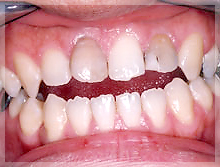 プラスティック材料で充填した症例 Before