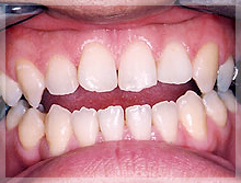 プラスティック材料で充填した症例 After