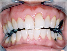 ホワイトニング症例 Before
