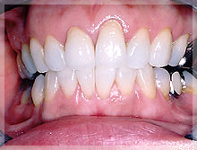 ホワイトニング症例 After
