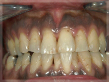 歯肉のメラニン除 Before